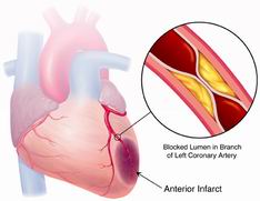 Инфаркт миокарда - ухудшение кроснабжения сердца