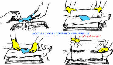 постановка горячего компресса