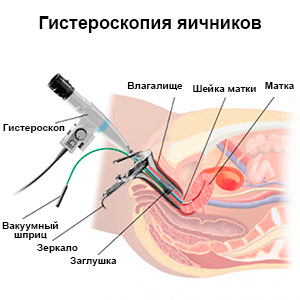 Гистероскопия в гинекологии
