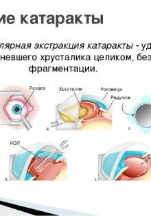 Как лечить катаракту?