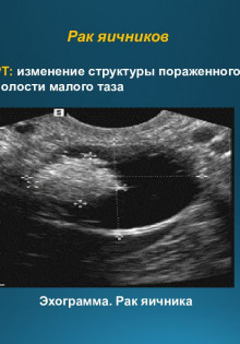 Грыжа Шморля: что это такое и почему она вызывает беспокойство?