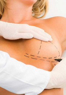 Как проводится пластика груди?