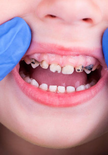 Лечение кариеса у детей