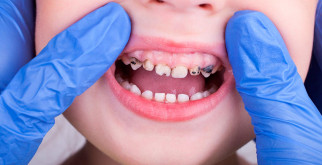 Лечение кариеса у детей