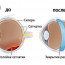 Как лечат отслойку сетчатки глаза?