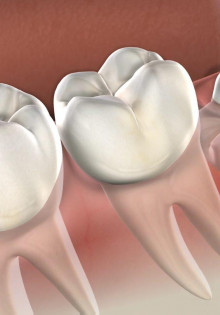 Удаление зуба мудрости: в чем заключается процедура и как ее правильно провести?