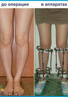 Дисплазия шейки матки неуточненная: что это значит и как с этим жить