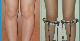 Дисплазия шейки матки неуточненная: что это значит и как с этим жить