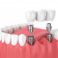 Когда стоит прибегать к имплантации зубов?