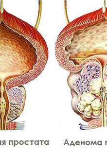 Аденома простаты: как предотвратить развитие и снизить риск?
