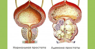 Аденома простаты: как предотвратить развитие и снизить риск?