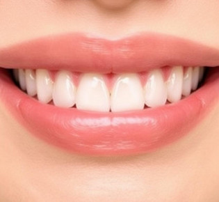 Виниры на зубы: что это такое, как делают и стоит ли ту дорогу улыбка