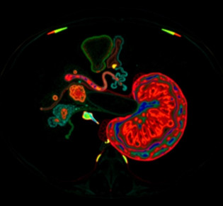 МРТ поджелудочной железы: как проходит исследование и что оно показывает