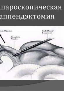 Быстро, точно, почти без следов: как проходит лапароскопическая аппендэктомия
