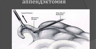 Быстро, точно, почти без следов: как проходит лапароскопическая аппендэктомия