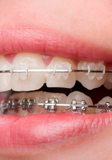 От чего зависит срок ношения брекетов