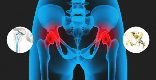 Лечение тазобедренного сустава: способы и их преимущества