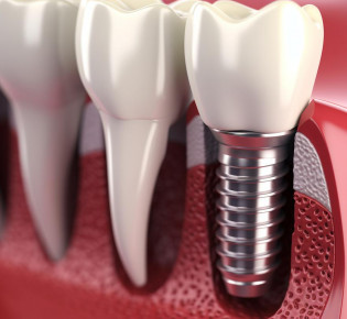 Имплантация зубов: восстановление уверенности в себе и прекрасной улыбки