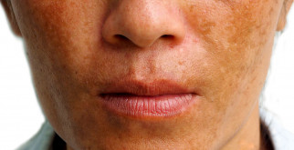 Проблема фотосенсибилизации: простые способы ее нейтрализации