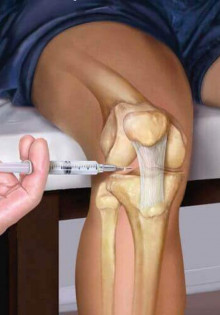 Как лечить коленный сустав