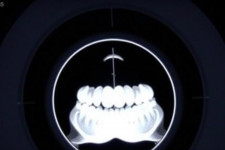 КТ зубов: зачем нужна трёхмерная съёмка и чего от неё ждать