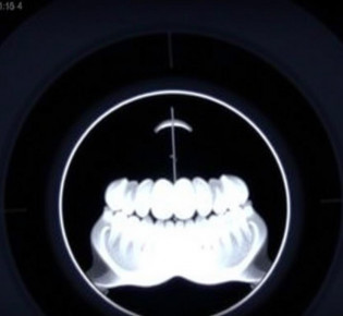 КТ зубов: зачем нужна трёхмерная съёмка и чего от неё ждать
