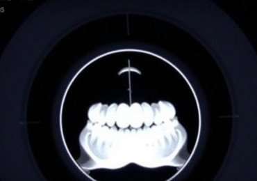КТ зубов: зачем нужна трёхмерная съёмка и чего от неё ждать