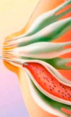 Внутрипротоковая папиллома: причины, симптомы и методы лечения