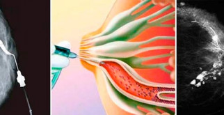 Серозометра матки после 60 лет: что это и почему важно знать