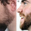 Не растет борода: почему так происходит и как найти решение