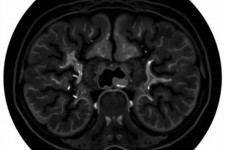 МСКТ ангиография брюшной аорты и артерий нижних конечностей в медицинском центре