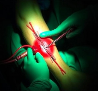 Тромбэктомия нижних конечностей: показания и техника