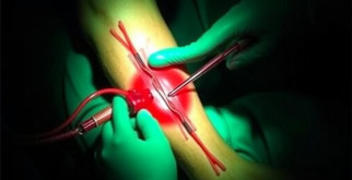 Тромбэктомия нижних конечностей: показания и техника