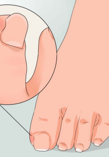 Как вылечить вросший ноготь?