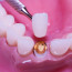 Какие коронки устанавливают в стоматологиях?