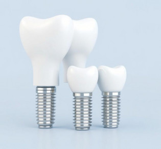 Имплантация зубов под ключ: от первой консультации до уверенной улыбки