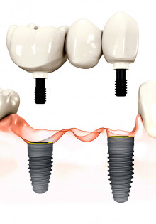 Виды имплантаций зубов