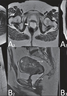 Жидкость в матке в пожилом возрасте: что это значит и как с этим бороться