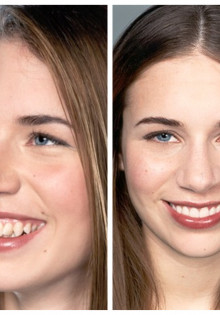 Что такое маловодие при беременности на 34 неделе