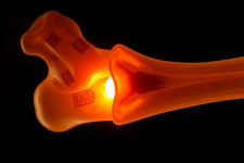 Диагностика и лечение асептического некроза кости