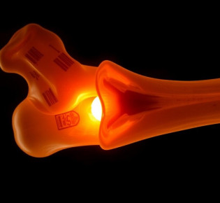 Диагностика и лечение асептического некроза кости