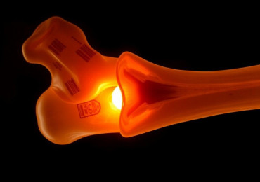 Диагностика и лечение асептического некроза кости