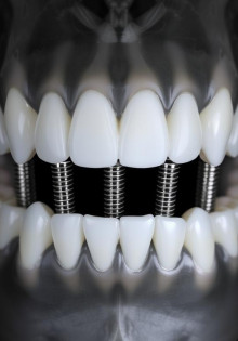 Имплантация зубов: все, что нужно знать об имплантах на 4 зуба