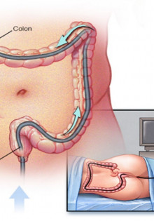 Как подготовиться к колоноскопии?