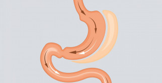 Бариатрическая хирургия: новые возможности для борьбы с ожирением