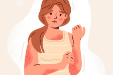 Кожа при атопическом дерматите