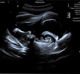 УЗИ органов малого таза: понятный гид — что смотрят, как подготовиться и чего ждать