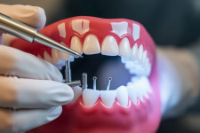 Имплантация зубов без мифов: когда можно ставить имплант сразу, а когда нужно ждать