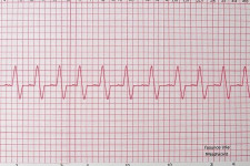 ЭКГ без паники: как читать линии на бумаге и понимать сердце