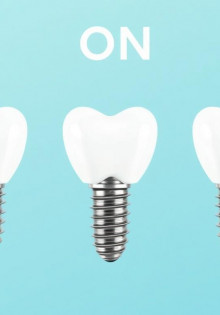 Имплантация зубов All-on-4: ваша улыбка — новая жизнь!